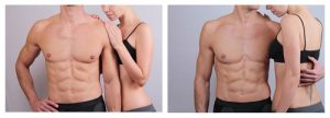 laser-hair-removal-coburg